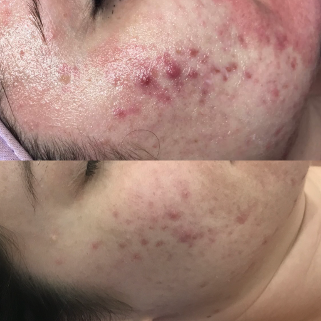 PRP/CGF Skin Rejuvenation